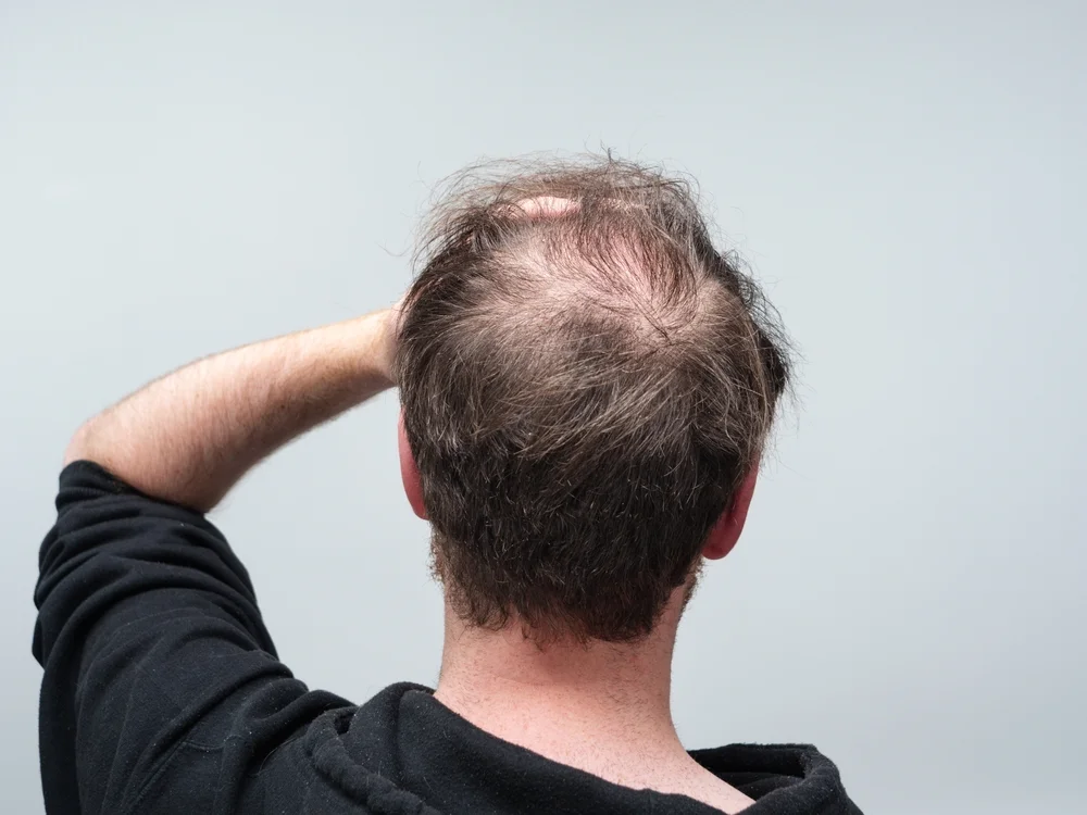 Is Hair Loss and Genetics related?