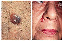 rostro de mujer con carcinoma de células basales