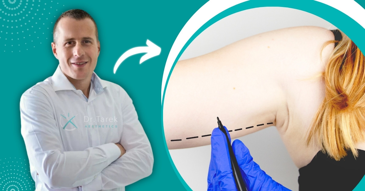 Arm Liposuction Before And After