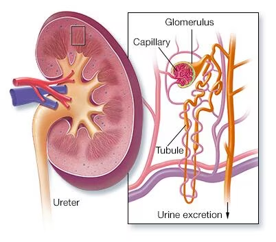     Nephrotic syndrome