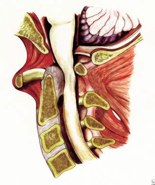 Rheumatoid Arthritis and Cervical Spine