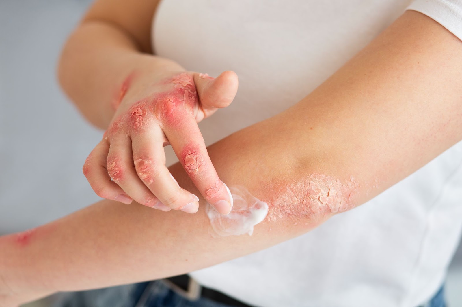Terapii Convenționale și Noi Perspective în Managementul Psoriazisului