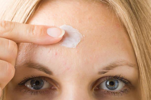 Young woman finger applying medical ointment on small pimples. Rash on forehead skin. Closeup. Front view. Young woman finger applying medical ointment on small pimples. Rash on forehead skin. Closeup. Front view. eczema face cream stock pictures, royalty-free photos & images
