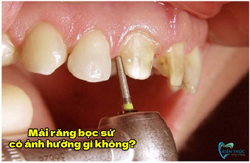 Bọc răng sứ không ảnh hưởng quá nhiều đến răng thật.