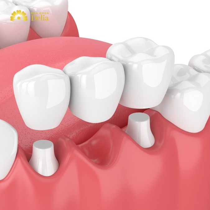Cầu răng sứ là gì? Loại cầu răng sứ nào phù hợp với bạn?