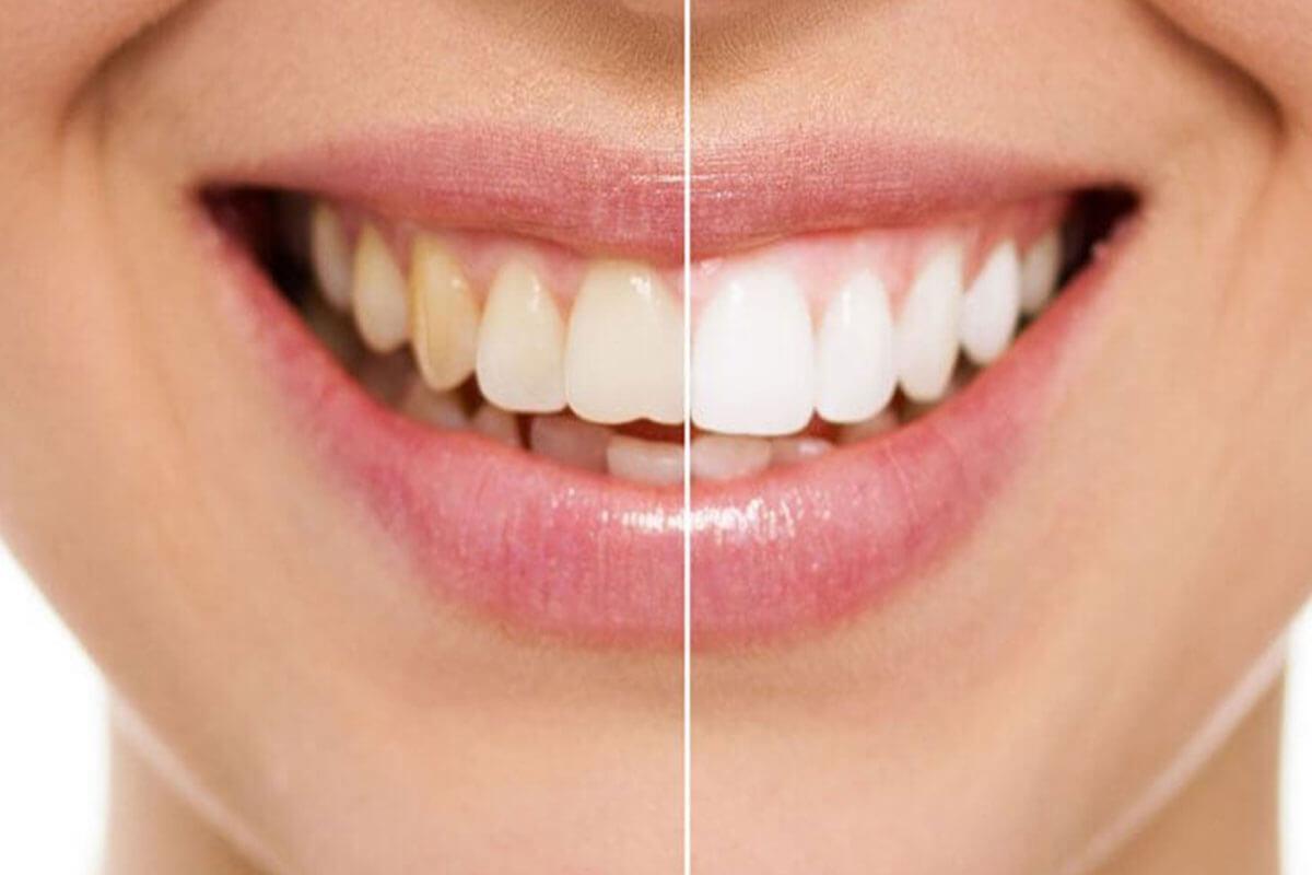 Richmond Hill teeth whitening