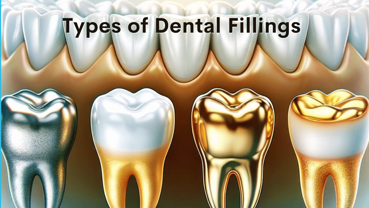 How Long Do Dental Fillings Last