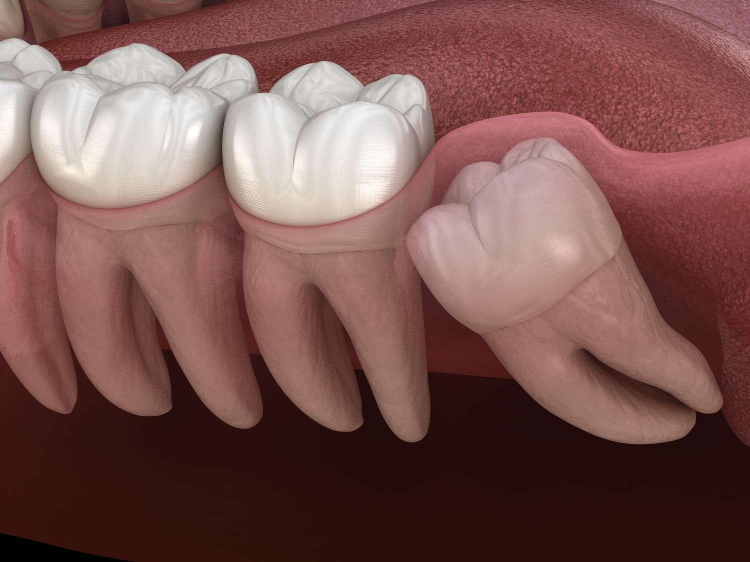 wisdom tooth extraction in Toronto