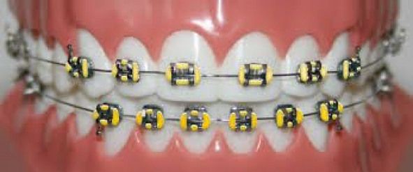 Yellow braces