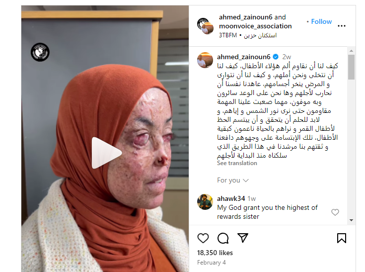 امرأة مغربية تعاني من مرض متلازمة جفاف الجلد
