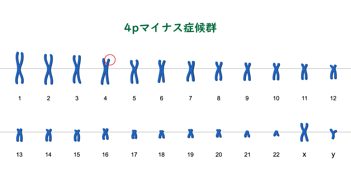 4pマイナス症候群の特徴と原因【染色体異常】 - 新型出生前診断 NIPT Japan