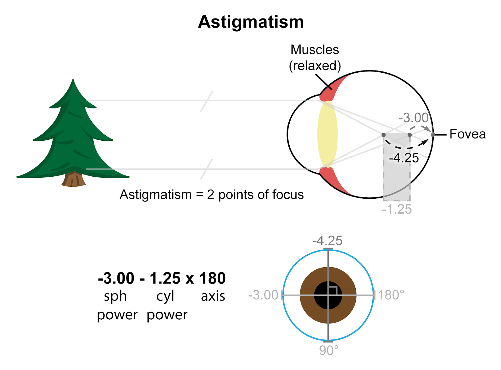 Astigmatism causes more than one point of focus in the back of the eye. The wider the gap between points, the more astigmatism. To correct each point, glasses or contact lenses need to have powers aligned in the proper meridian