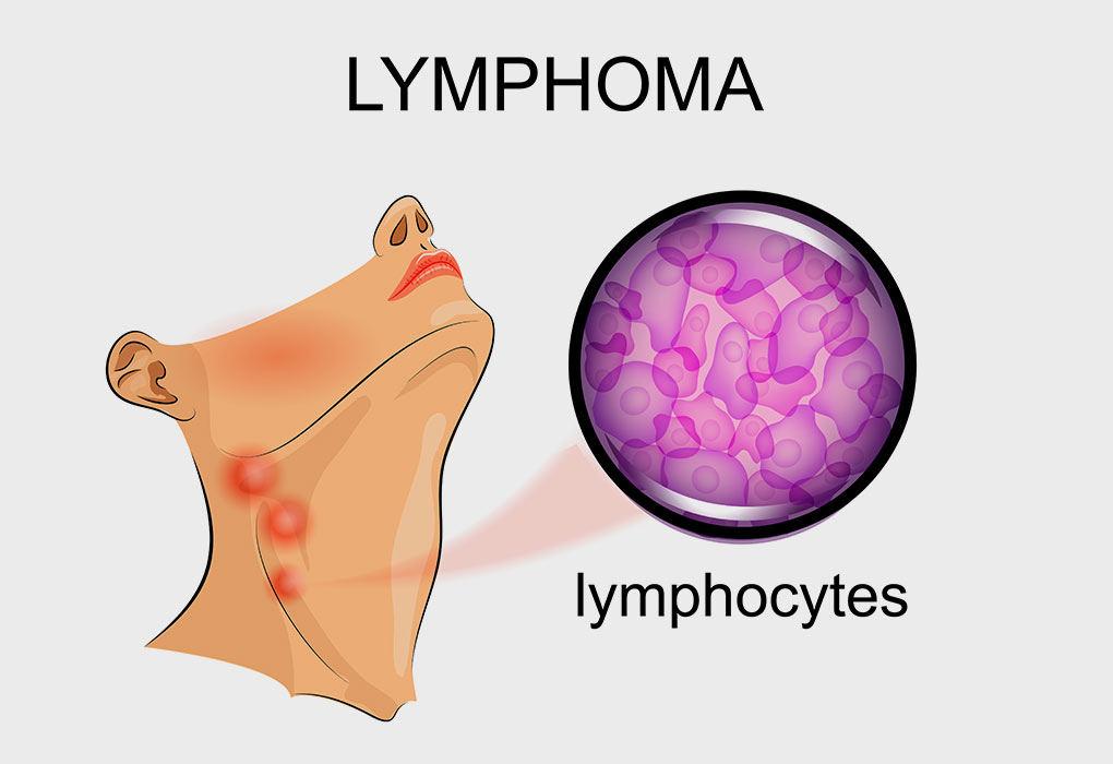 Lymphoma