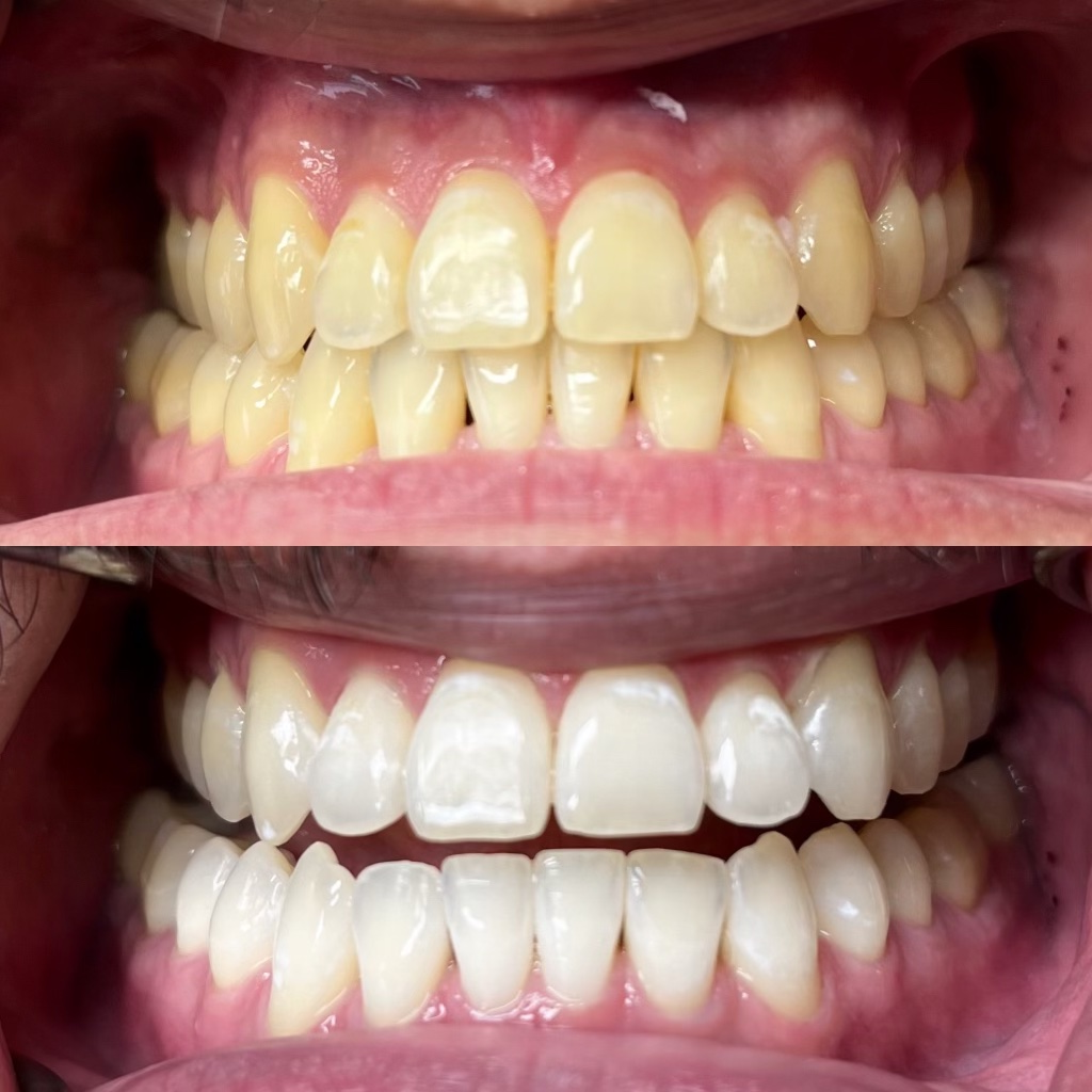 teeth whitening in Burnaby