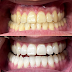 What Is the Best Method for Teeth Whitening?