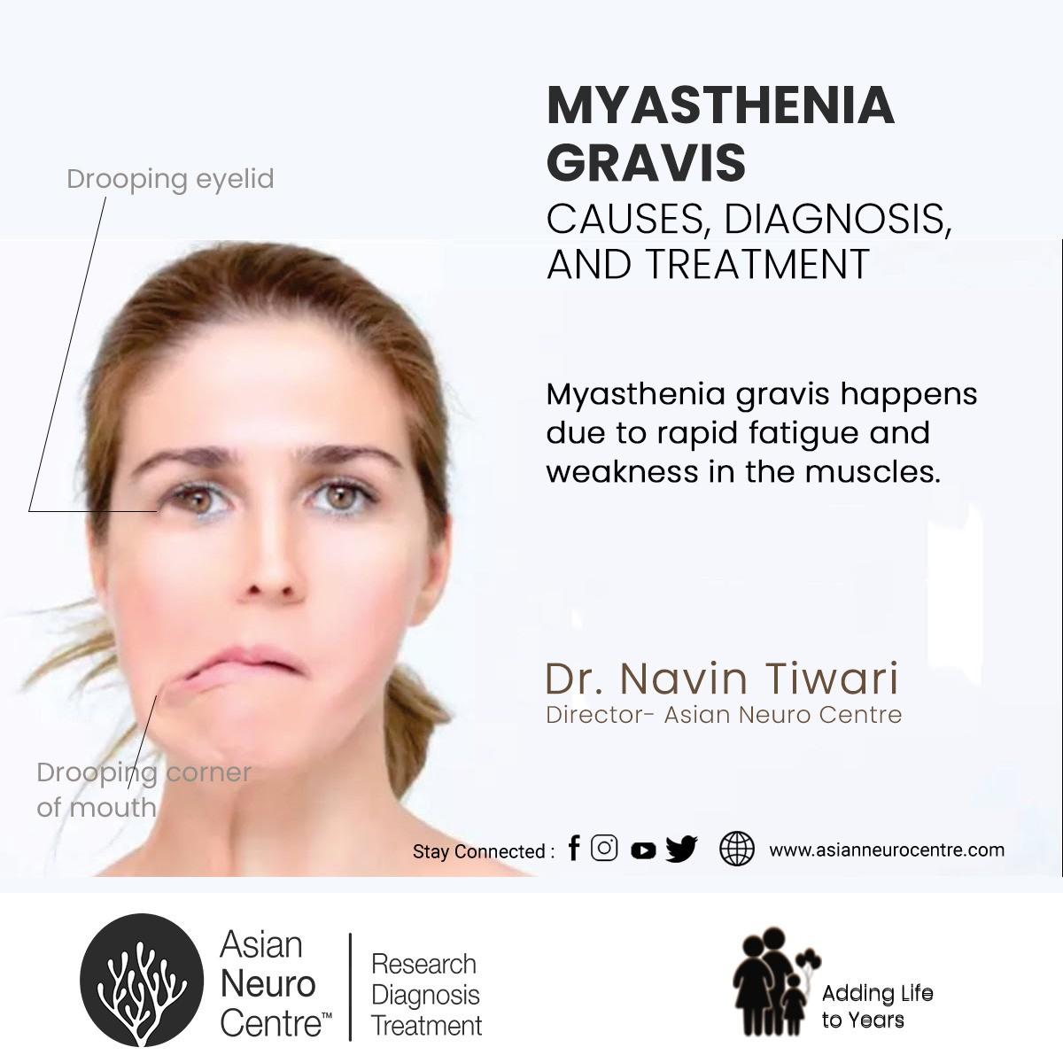 Myasthenia