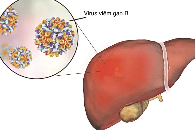 Viêm gan B là bệnh lý truyền nhiễm nguy hiểm gây bệnh ở gan do virus Hepatitis B Virus (HBV) gây ra