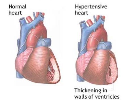 Long-Term Risks of Genetic Hypertension for Young Adults