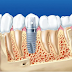 Yếu Tố Ảnh Hưởng Đến Mức Độ Đau Khi Trồng Răng Implant Mỹ