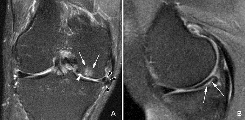 mri-for-meniscus-tear-and-cartiliage-loss