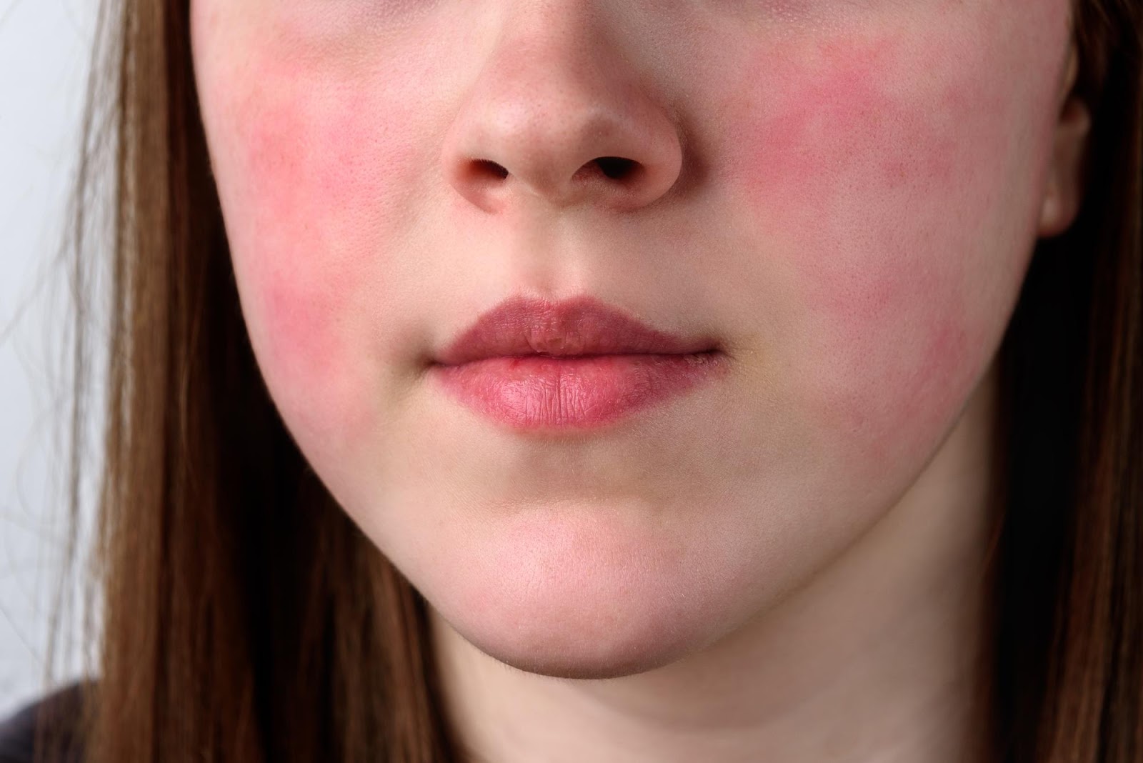 Arrossamento della pelle: Allergia o altra condizione?