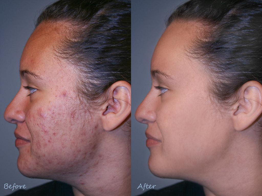 Before and after image of acne on face.
