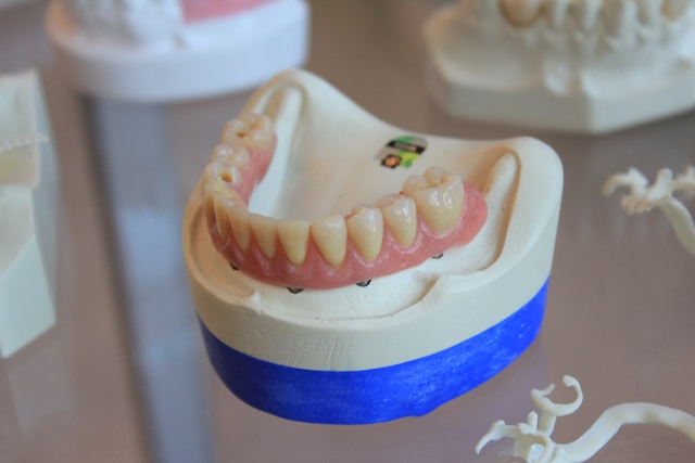 Why You Need The Top Quality Dental Implants Services