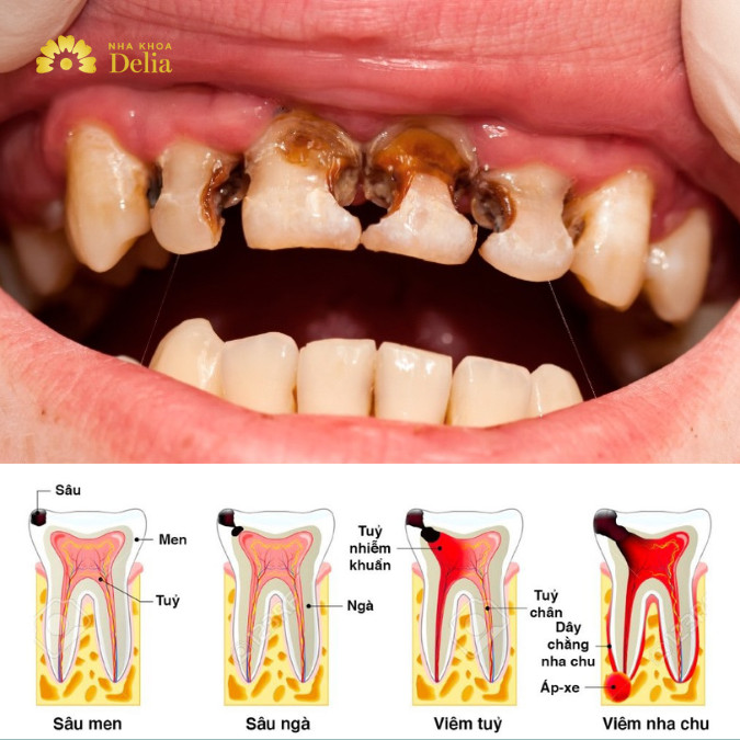 Các giai đoạn phát triển của răng sâu