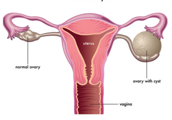 Ovarian Cyst 