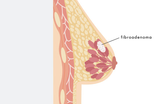 fibroadenoma mamário