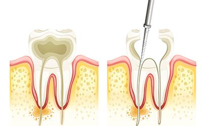 endodontics in Toronto