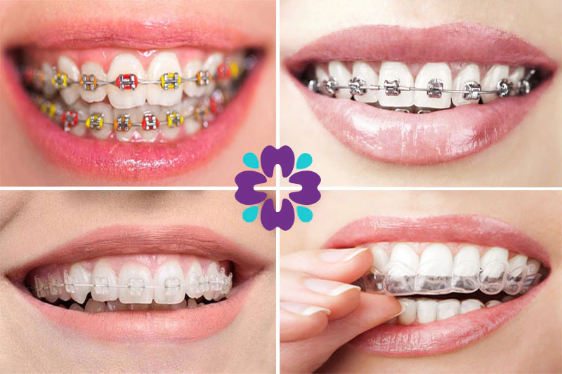 hình ảnh mô tả 4 loại niềng răng mắc cài bao gồm mắc cài kim loại đủ màu sắc, mắc cài kim loại truyền thống, mắc cài kim loại sứ, khay niềng trong suốt invisalign
