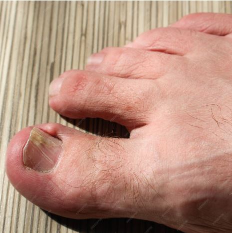 Why Do Blisters Formation Occur