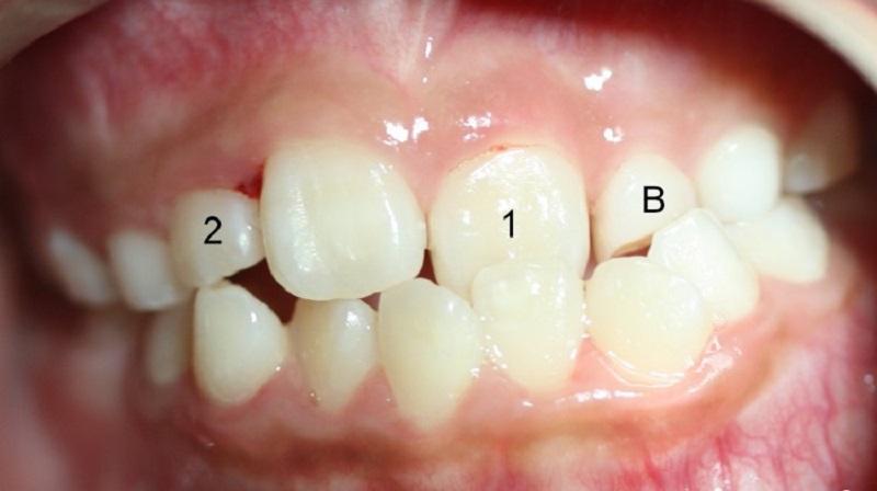 Close-up of a person's teeth

Description automatically generated