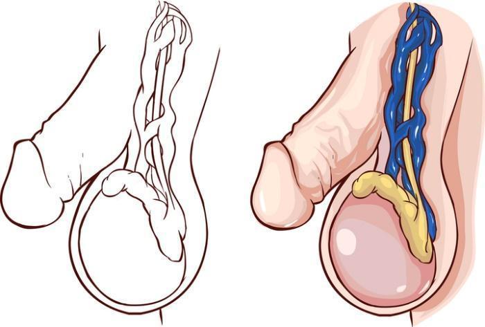 Understand Varicocele Symptoms Causes And Treatment Options