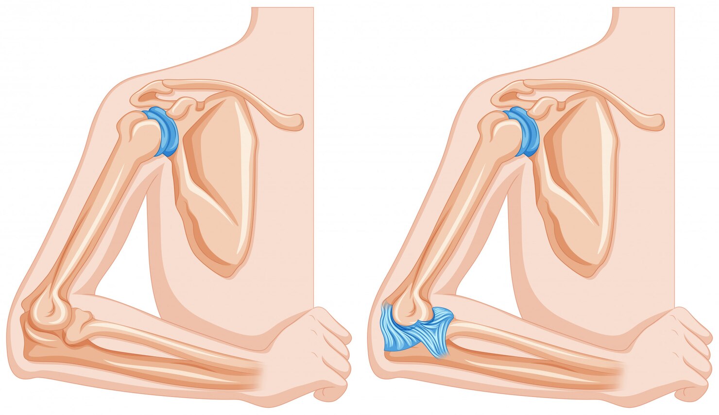 Cấu trúc xương cánh tay