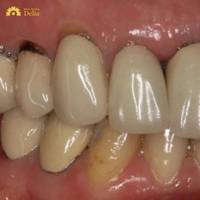 Đặc trưng của dòng răng sứ Zirconia Trung Quốc