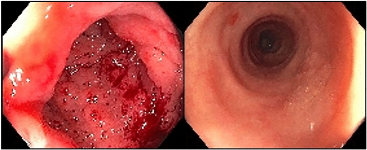 What Is Diversion Colitis? 8 Things To Know | MyCrohnsAndColitisTeam