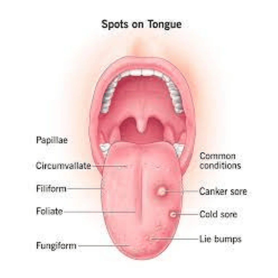 How to Get Rid of Bump on Tongue