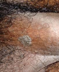Condyloma acuminatum (Genital warts) - Dermatology Advisor
