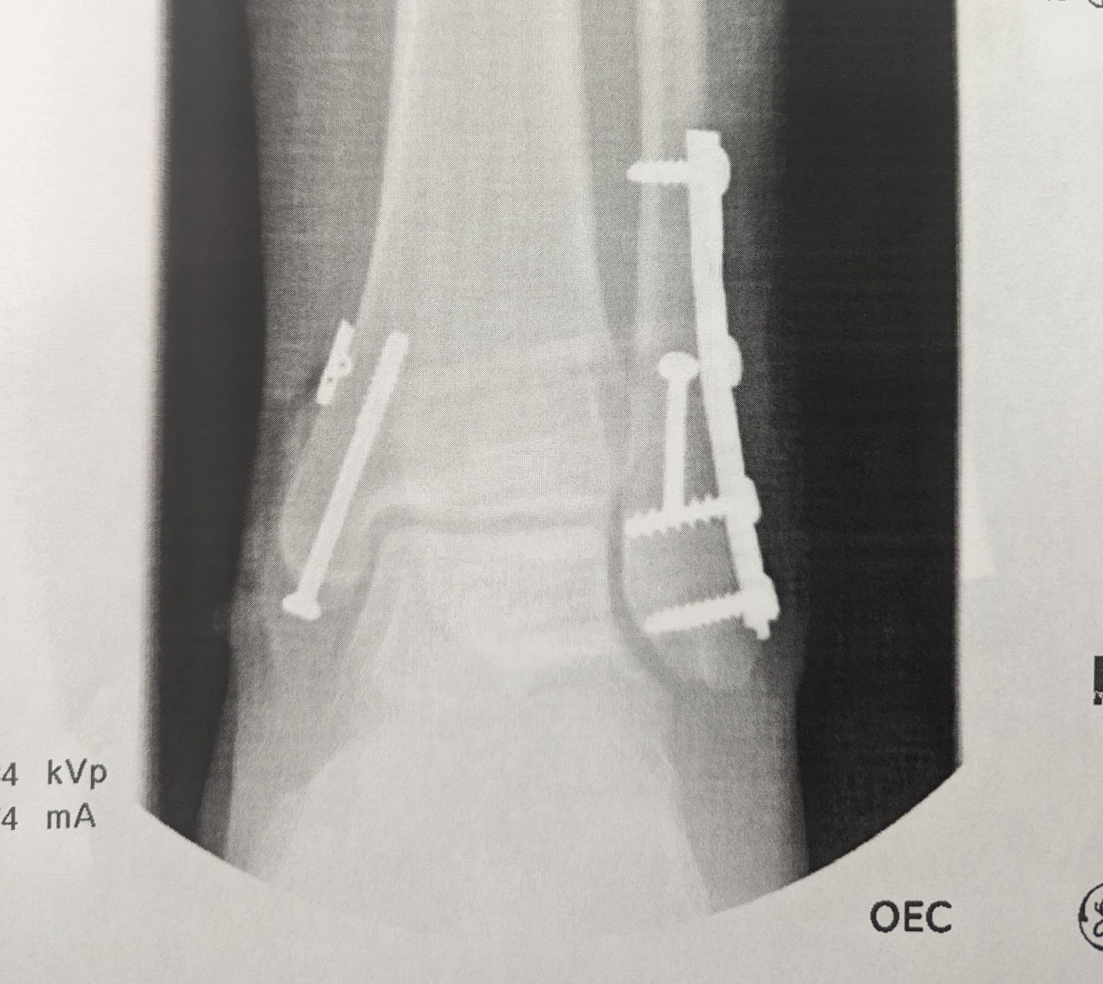 A photo of an X-ray with an injured ankle.