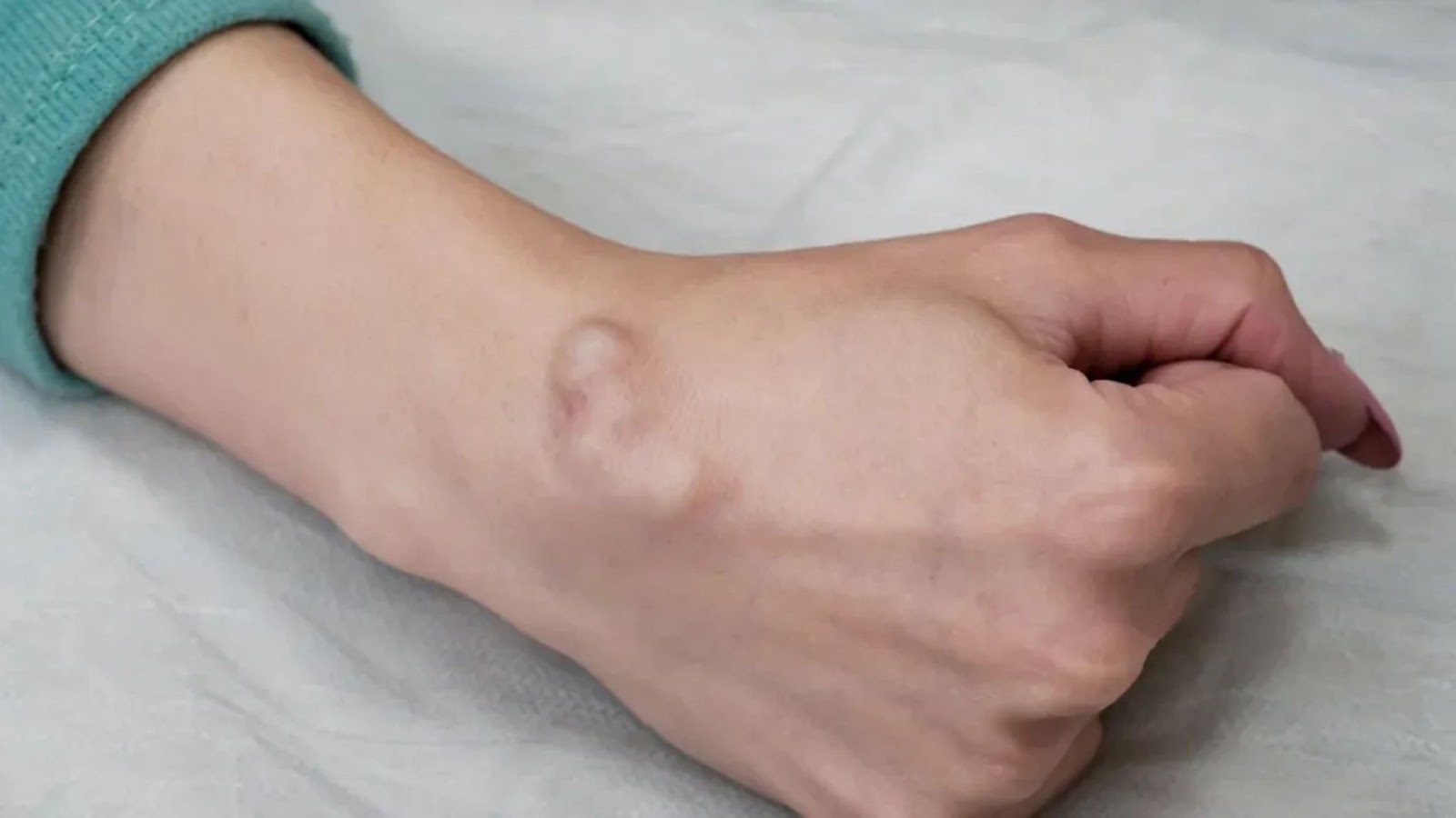 ganglion cyst vitamin deficiency