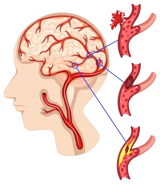 What Causes Acute Symptomatic Seizures?