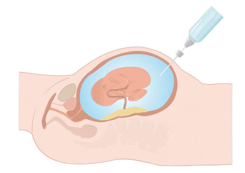 Chọc ối là một trong những phương pháp xâm lấn trong xét nghiệm huyết thống thai nhi 