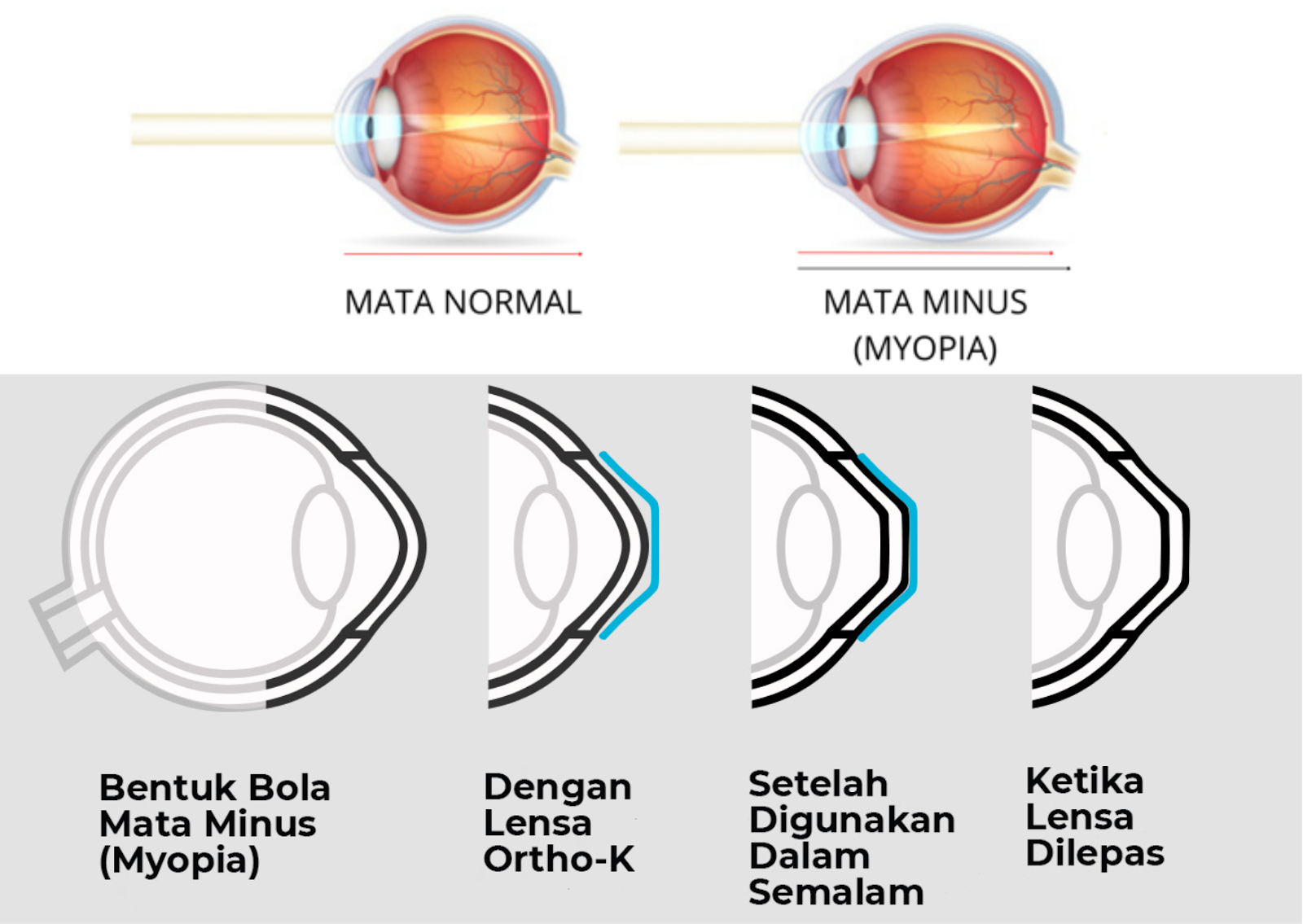 Bebas Kacamata 