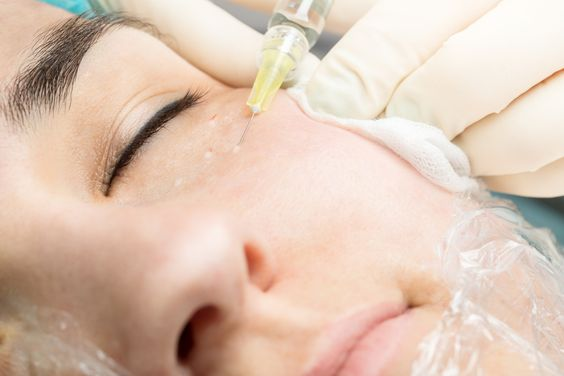 Another picture of a lady using botox under eyes treatment