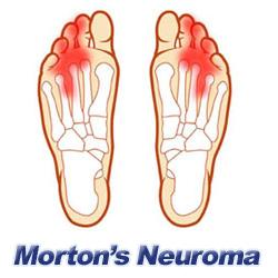 http://heel-that-pain.com/images/mortons_neuroma.jpg