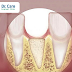 Cách chữa tiêu xương răng hiệu quả nhất hiện nay - Chi phí điều trị giá bao nhiêu?