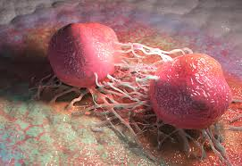 Prostate cancer