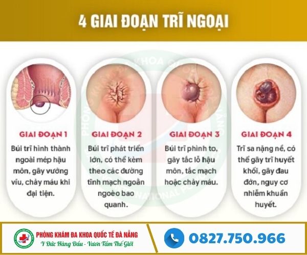 Các giai đoạn của bệnh trĩ